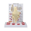 Gpi Anatomical Anatomical Model - Knee - Meniscus Tears 1010